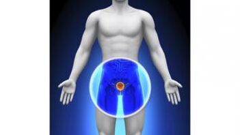 prostatitis in a man