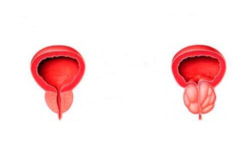 healthy and inflamed prostate with prostatitis