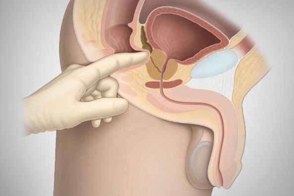 Prostate massage for bacterial prostatitis